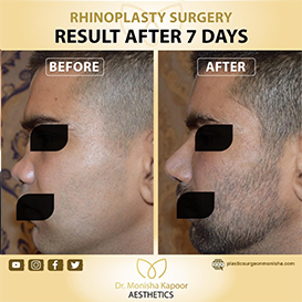 rhinoplasty-img13